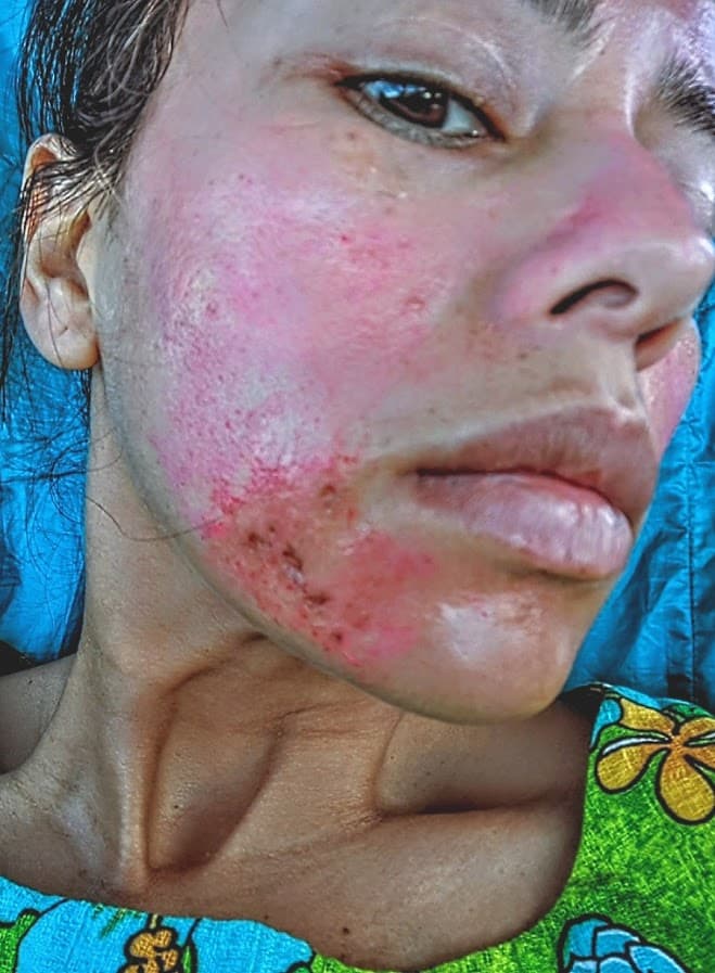 A spreading, painful facial rash. A visible sign of an invisible battle.