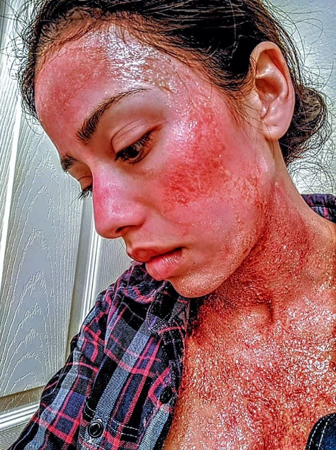 Severe lesions cause scarring, hair loss, and debilitating pain.